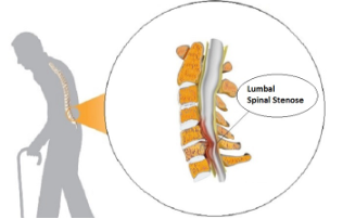 Spinalstenose